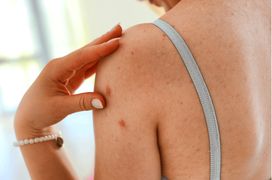 The Connection Between Exfoliation & Body Acne